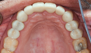 Treatment of Severe Dental Erosion Utilizing Direct Composite to Phase Treatment