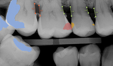 The Impact of Dental Artificial Intelligence for Radiograph Analysis