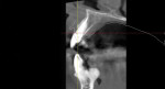 A cone-beam computed tomography (CBCT) scan was acquired of the tooth No. 10 site.