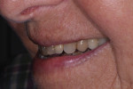 Preoperative left lateral smile photograph.