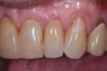Posttreatment smile photograph and close-up and left lateral close-up photographs of tooth No. 10, which was restored with a custom abutment and a lithium disilicate crown that was cemented into place due to the overall size of the access relative to the final restoration. The patient stated that she was very happy with the outcome.