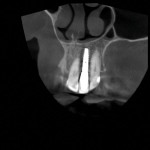 Five-year postoperative CBCT scans demonstrating the long-term healing achieved.
