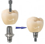 Screw-retained restorations utilizing a Ti base have the zirconia portion of the restoration luted to the metal Ti base, which is then fixated intraorally to an implant either directly or to an MUA on the implant.