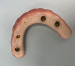 A hybrid prosthesis that had the Ti base detach from the prosthesis and remain intraorally on the implant, with the Ti base still connected to the prosthesis at the other three implant sites.