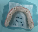 The tissue-side view of a hybrid prosthesis fabricated without a Ti base to connect the prosthesis to the MUA intraorally.