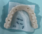 Occlusal view of a hybrid prosthesis fabricated without a Ti base to connect the prosthesis to the MUA intraorally.