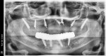 A maxillary PMMA hybrid retained to the implants with screws.