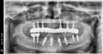 A mandibular PMMA hybrid retained to implants with screws.