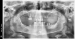 A pre-operative radiograph confirms the patient’s failing dentition.