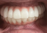The final zirconia restorations in the mouth.