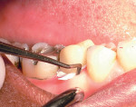 Figure 4  Removing excess provisional cement with a scaler.