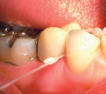 Figure 5  Removing excess provisional cement from the interproximal gingival embrasure with a piece of dental floss that has been knotted several times on the end.