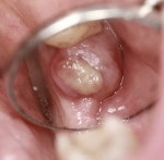 Fig 1. Intraoral clinical photograph demonstrating a 6 mm x 6 mm ulcerated, yellowish dome-shaped nodule in edentulous site No. 18.