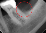 Fig 2. Periapical radiograph showing severe vertical bone loss and bony sequestrum distal to tooth No. 19.