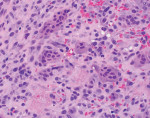 Fig 4. High-power magnification of the submitted specimen showing scattered multinucleated giant cells within a hemorrhagic background of ovoid- and spindle-shaped mesenchymal cells.