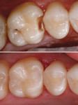 Fig 1. Prior to treatment (top). Post-treatment with Bulk EZ PLUS™ (bottom). Note excellent shade matching and blending with natural tooth structure.