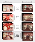 Fig 1. Direct comparison of clinical images (left column) and surgical simulator images (right column) showing a sample procedure: placement of a dental implant.