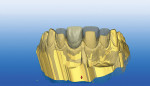 Figure  1  DIGITIAL CAPABILITIES Design software allowed the operator to overlay a virtual wax-up model over the virtual preparation model to precisely propose and design restorations dimensionally identical to wax-up.