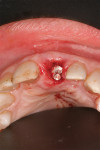 Figure 6  Immediate temporary abutment in place with bone graft material between the buccal plate and implant.