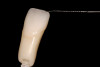 Figure 2  Congenitally missing maxillary right lateral incisor.