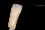 Figure  6  DIGITIAL CAPABILITIES Subtle blue and white stains were used to highlight incisal stump mamelon effects and then oven-fired.