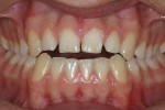 Figure  10  CASE PRESENTATION Preoperative view shows esthetic microdontia, diastemas, and anterior open bite due to tongue thrust (orthodontic referral for esthetic completion).
