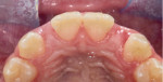 Palatal and retracted facial views of the increased tissue volume at the lateral incisor sites following connective tissue grafting.