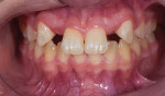 Palatal and retracted facial views of the increased tissue volume at the lateral incisor sites following connective tissue grafting.