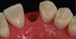 Tooth model demonstrating the technique used to prepare the canine abutment teeth for bonded single-wing zirconia bridges. Note the anti-rotation groove placed on the mesial aspect of the canine abutment.