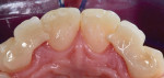 Posttreatment palatal view of the bonded zirconia bridges. Note the anti-rotation extensions of the framework that contact the palatal surfaces of the central incisors.