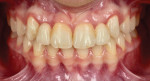 Posttreatment retracted and smile views of the bonded zirconia bridges.