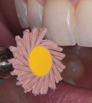 Medium and fine grit Dialite Feather Lite polishers being used on the incisal edges of a ceramic restoration.