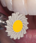 Medium and fine grit Dialite Feather Lite polishers being used on the incisal edges of a ceramic restoration.