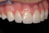Figure 17  Implant placement into augmented ridge at 7 months.