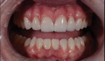 Fig 2. Retracted view of anterior restorations utilizing lithium disilicate for an esthetic result (Courtesy of Joshua Polansky, MDC).