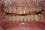 Fig 1. Close-up view of patient’s dentition in 2009.