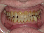 Fig 2. Close-up view of patient’s dentition in 2017 showing increased facial and buccal erosion over the past 8 years.