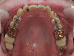 Fig 8. Pretreatment occlusal view of maxillary arch.