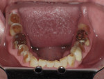 Fig 9. Pretreatment occlusal view of mandibular arch.