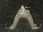 Fig 10. Notched deprogrammer at midpoint on platform from awake bruxism (clenching).
