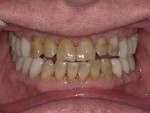 Fig 11. Frontal view of posterior zirconia crowns post-treatment.