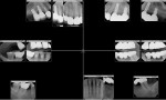 Fig 1. Full-mouth radiographs of patient preoperatively.