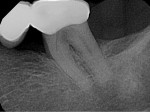 Fig 2. Preoperative periapical radiograph of tooth No. 18.