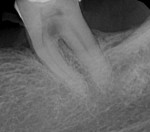 Fig 3. Preoperative periapical radiograph of tooth No. 18 after initial fixed partial prosthesis removal showing clear furcal decay.