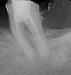 Fig 4. Periapical radiograph of tooth No. 18 following root canal treatment, showing two canals.