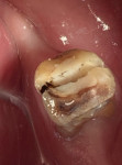 Fig 5. Postoperative intraoral photograph of tooth No. 18 following hemisection and crown-lengthening.