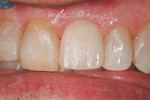 Figure 9  Provisional restoration of tooth No. 9 at 4 weeks postoperative.