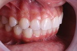 Fig 2 and Fig 3. Intraoral preoperative photographs: right lateral retracted view (Fig 2) and frontal retracted view (Fig 3). Demonstrated characteristics of the patient’s intermediate gingival biotype included small papillae, incisors with a rectangular characteristic, and contact surface in the interproximal regions.