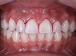 Fig 11. Excision of the gingival layer, which was done with a periodontal curette.