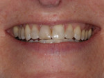Figure 2  The full smile displayed a short thin upper lip and a reverse smile line. There was a gummy display on the upper left.